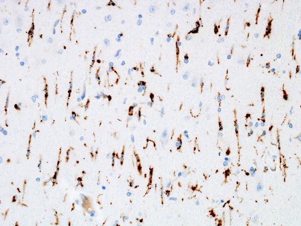 5 Hypoxia-Ischemia (Case 2) Microglia, temporal cortex CD68 7A