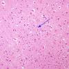 7A1 Hypoxia-Ischemia, Neuron loss (Case 7) H&E 3