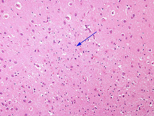 7A1 Hypoxia-Ischemia, Neuron loss (Case 7) H&E 3