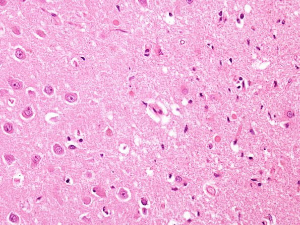 7A2 Hypoxia-Ischemia, Neuron loss (Case 7) H&E 4