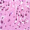 8A1 Hypoxia-Ischemia, neonate (Case 5) 1