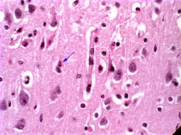 8A1 Hypoxia-Ischemia, neonate (Case 5) 1