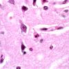 8A2 Hypoxia-Ischemia, neonate (Case 5) 2