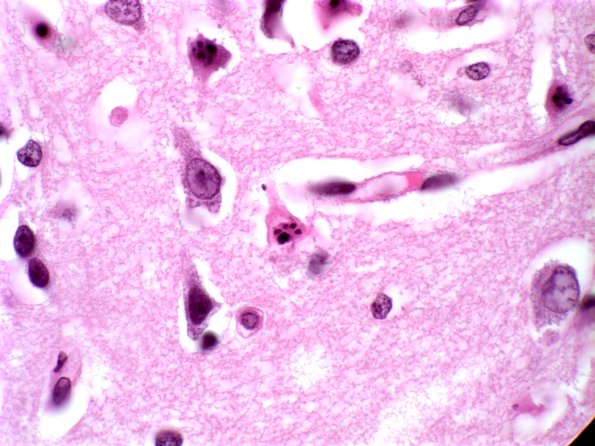 8A2 Hypoxia-Ischemia, neonate (Case 5) 2