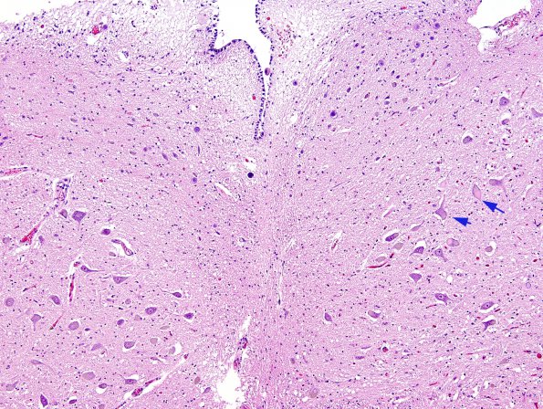 1A1 Inclusion, colloid body (Case 1) N8 medulla H&E 8