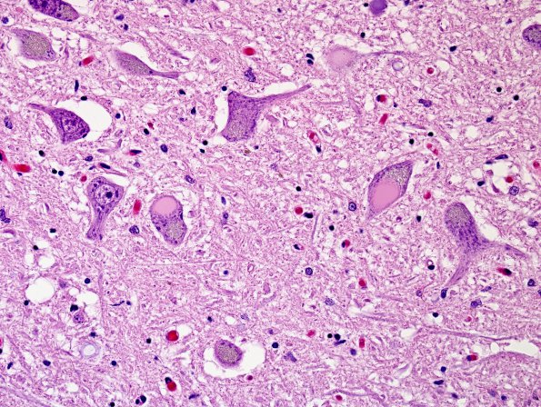 1A2 Inclusion, colloid body (Case 1) N8 medulla H&E 2