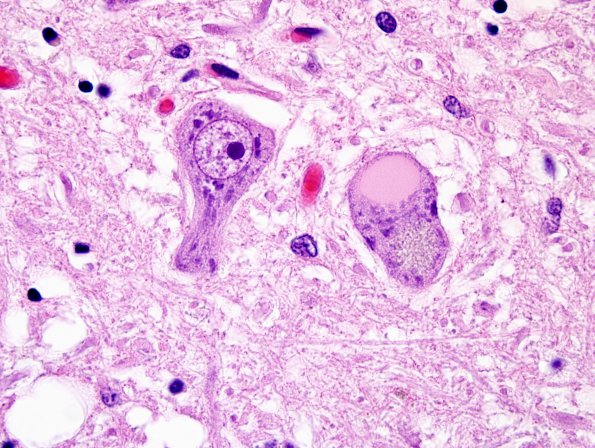 1A3 Inclusion, colloid body (Case 1) N8 medulla H&E 7