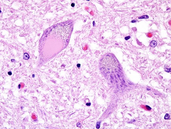 1A4 Inclusion, colloid body (Case 1) N8 medulla H&E 10