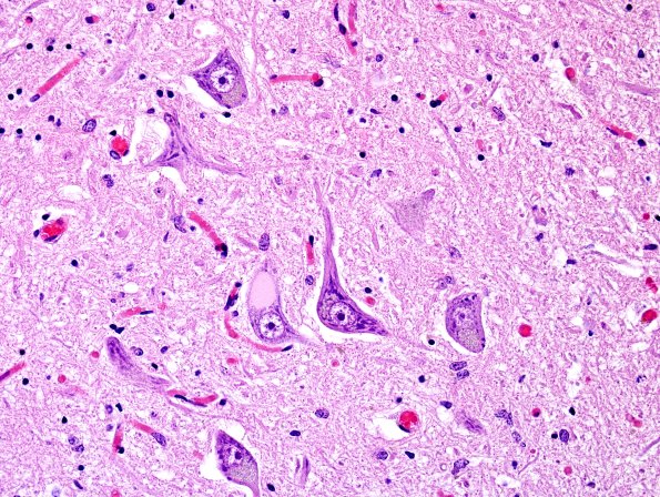 1A5 Inclusion, colloid body (Case 1) N8 medulla H&E 4A.jpg