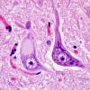 1A6 Inclusion, colloid body (Case 1) N8 medulla H&E 6