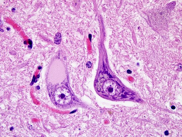 1A6 Inclusion, colloid body (Case 1) N8 medulla H&E 6