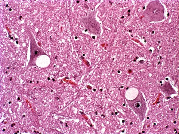 2 Inclusion, colloid, Hypoglossal (Case 4) H&E 1A