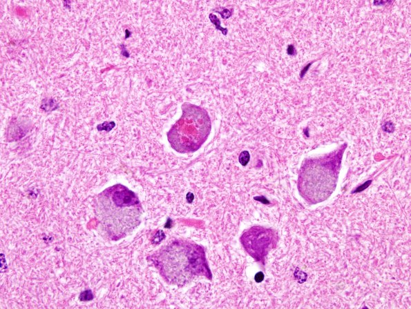 3A1 Inclusion, ION (Case 2) H&E 2