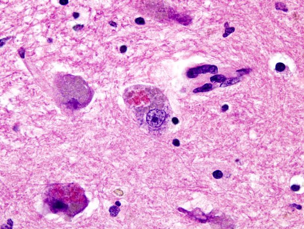 4A1 Inclusion, ION (Case 3) H&E 1