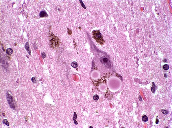 1A1 Parkinsons Dz H&E 1 Lewy body