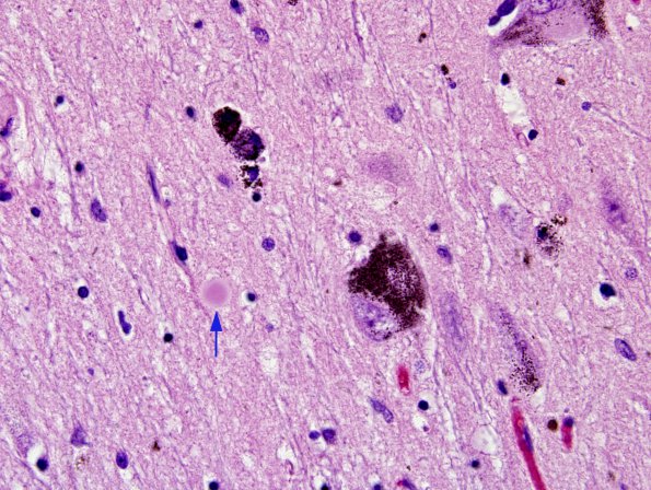 1A3 PD, extracellular Lewy body H&E 1