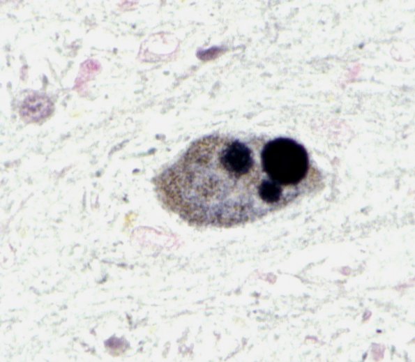 2 Lewy body, alpha-synuclein