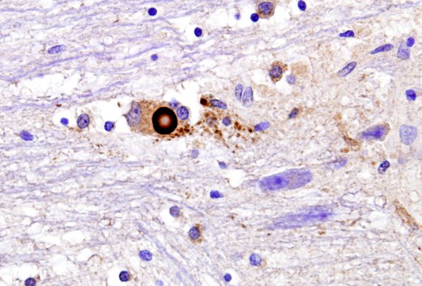 3 Parkinson's Dz Lewy Body (Case 3) A-SYN