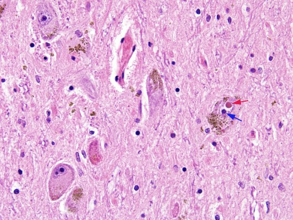 1A1 Parkinson's Dz (Case 2) SNigra H&E 5