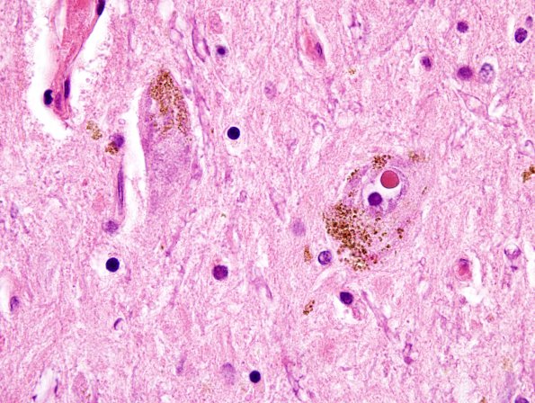 1A2 Parkinson's Dz (Case 2) SNigra H&E 3