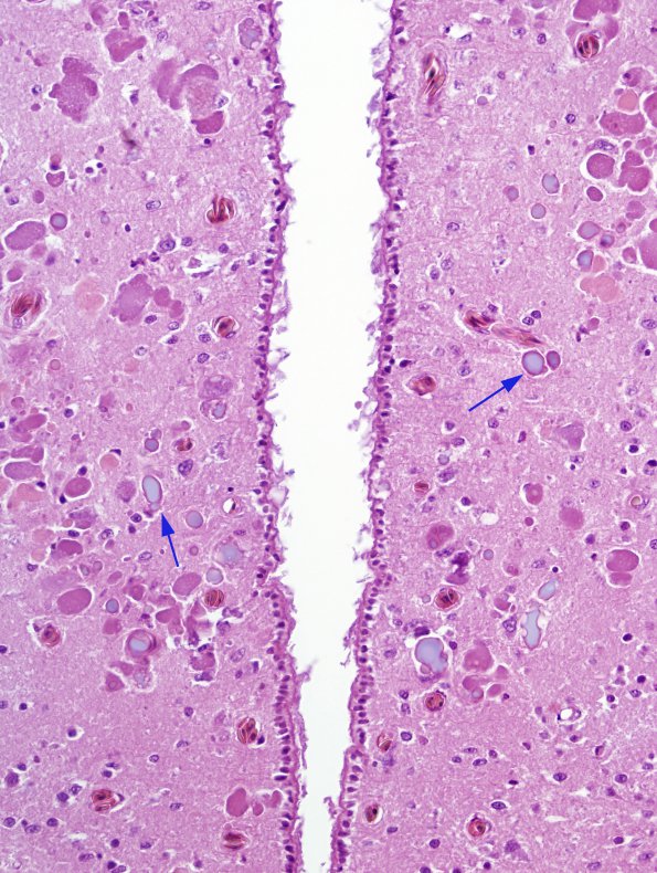 1A2 Inclusion, may be corpora amylacea, Viper, transcaucasian (ZOO) H&E 3