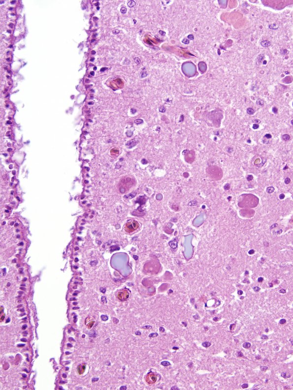 1A3 Inclusion, may be corpora amylacea, Viper, transcaucasian (ZOO) H&E 4