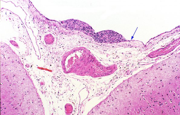 1 Leptomeninges, arachnoidal cap cells