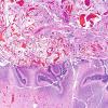 2 Leptomeninges, 35 wk fetus (Case 2) H&E 6