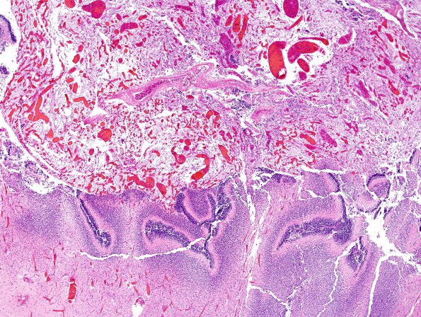 2 Leptomeninges, 35 wk fetus (Case 2) H&E 6