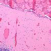 3A1 Leptomeningeal vascular engorgement (Case 1, 10 mo) H&E 2