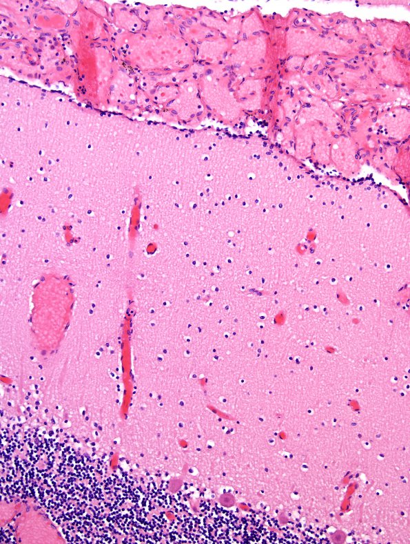 3A1 Leptomeningeal vascular engorgement (Case 1, 10 mo) H&E 2