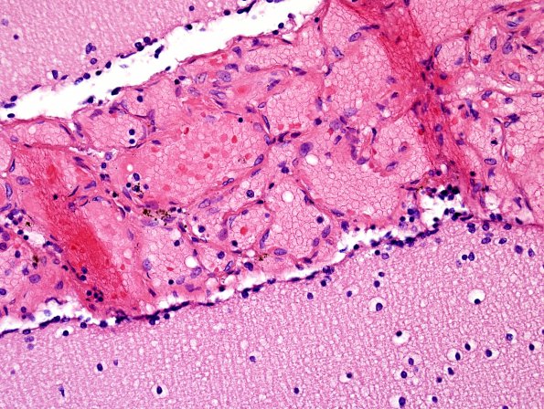 3A2 Leptomeningeal vascular engorgement (Case 1, 10 mo) H&E 1