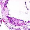 4 Leptomeninges, unusual inclusions (Case 3) H&E 1