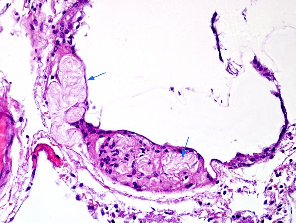 4 Leptomeninges, unusual inclusions (Case 3) H&E 1