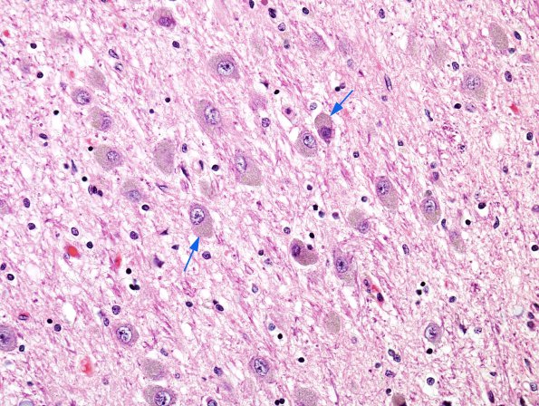 2 Lipofuscin LGN (Case 2) H&E