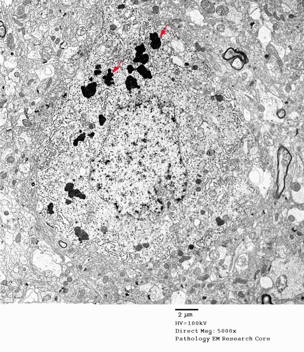 5A1 Lipofuscin, neuron (Case 3) EM 037 - CopyA