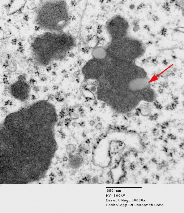 5A2 Lipofuscin, neuron (Case 3) EM 040 - Copy