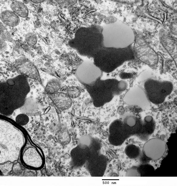 6A1 Lipofuscin (Case 1) EM 007 - Copy