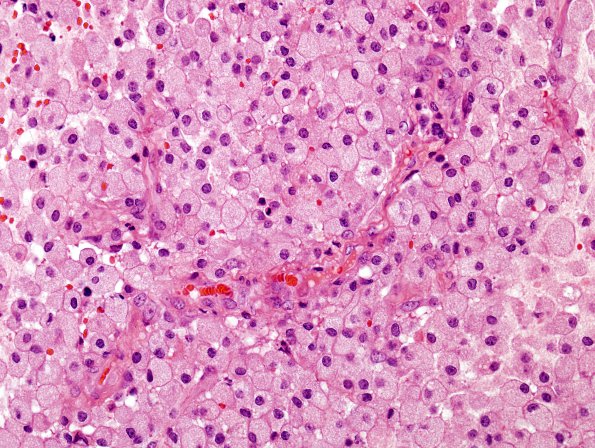 1 Macrophages (Case 6) H&E 2