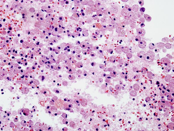 2A1 Macrophages (Case 7) 1 H&E