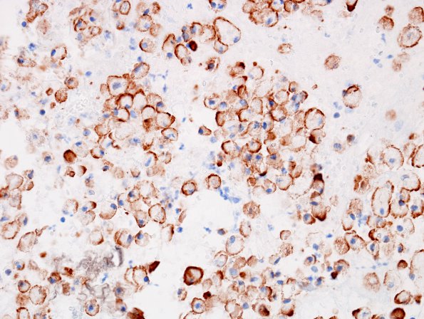 2A2 Macrophages (Case 7) CD163