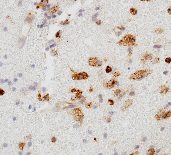 3 Macrophages (Case 8) CD68 2