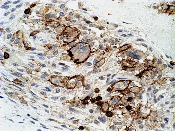 4 Macrophages (Case 9) MT-1