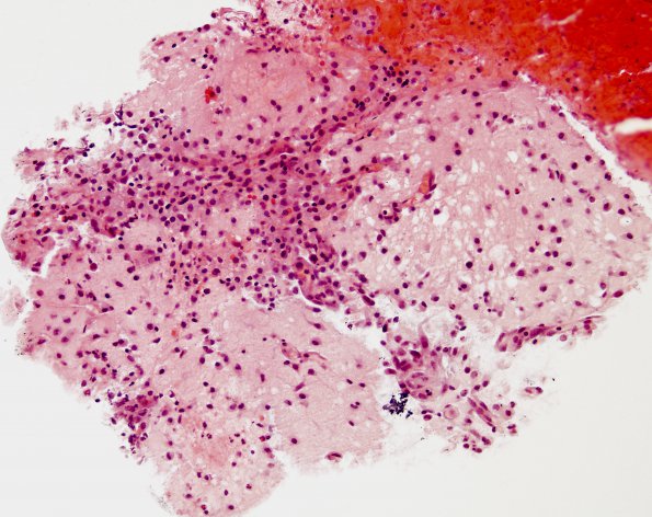 5A1 Macrophages (Case 5) Selected Area A 1 H&E