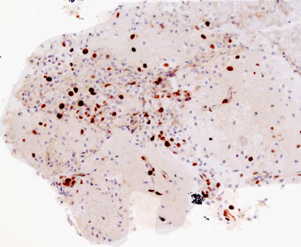 5A3 Macrophages (Case 5) Selected Area A 3 MIB-1