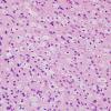 5A4 Astrocytosis & Macrophages (Case 5) 2 H&E 1