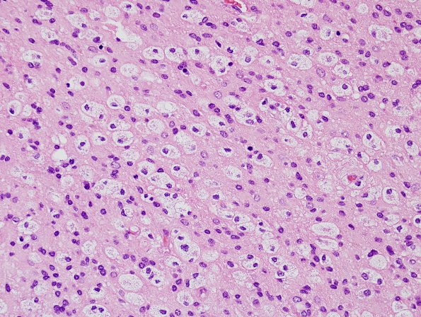 5A4 Astrocytosis & Macrophages (Case 5) 2 H&E 1