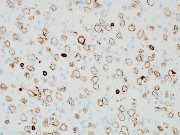 5A5 Astrocytosis & Macrophages (Case 5) 3 CD45 1