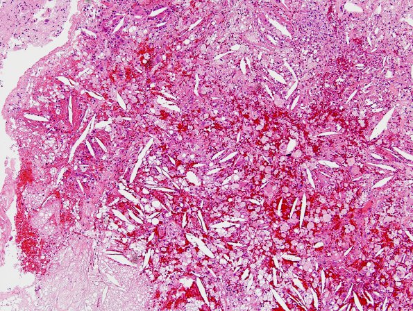 7A1 Cholesterol clefts (Case 2) H&E 1