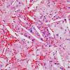 7A2 Cholesterol clefts (Case 2) H&E 2